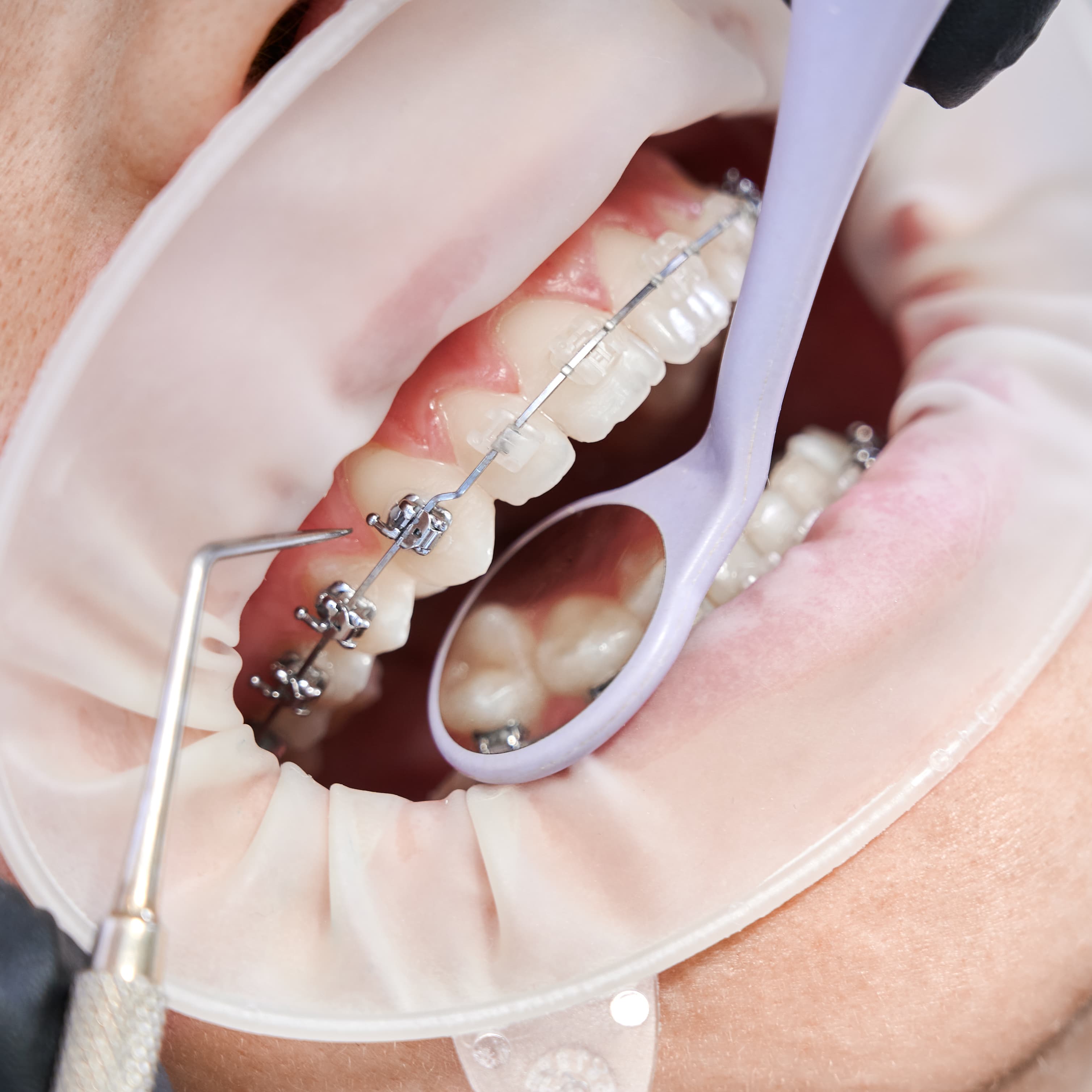 A small detail that makes your smile shine.