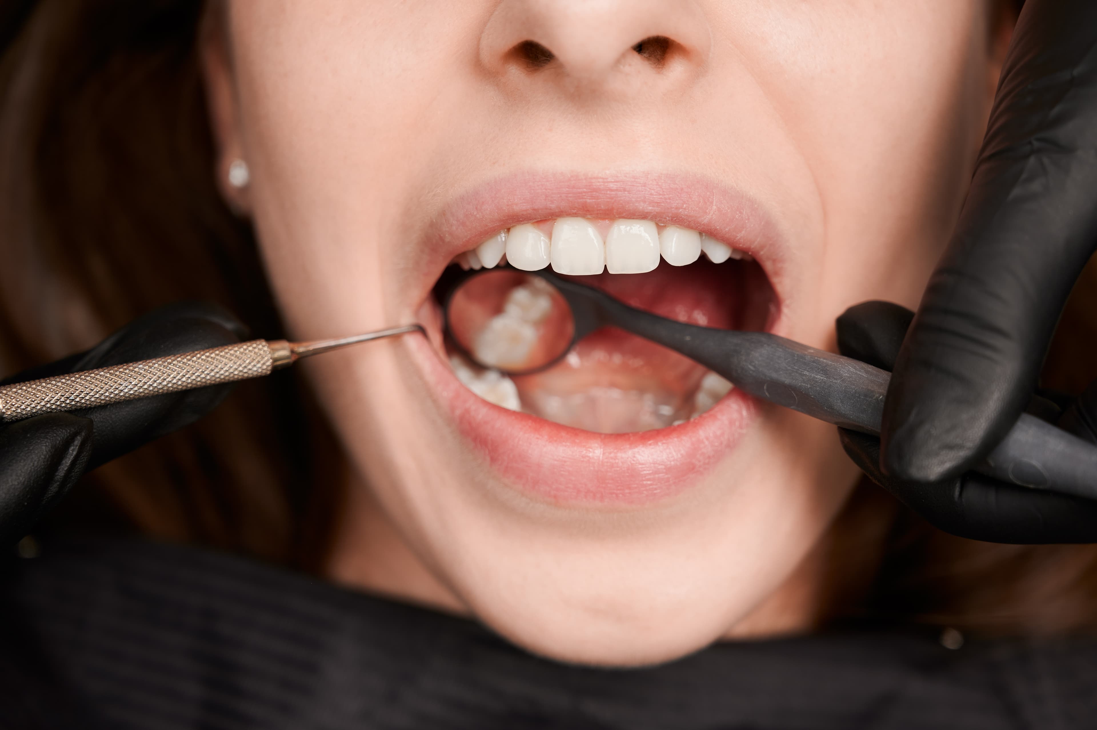 MAMA Dental Clinic Gum Contouring